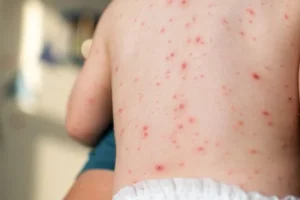 How to prevent chickenpox in children
